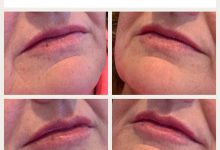 0.5ml Restylane Kysse Lip Enhancement