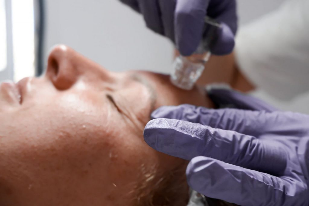 Microneedling