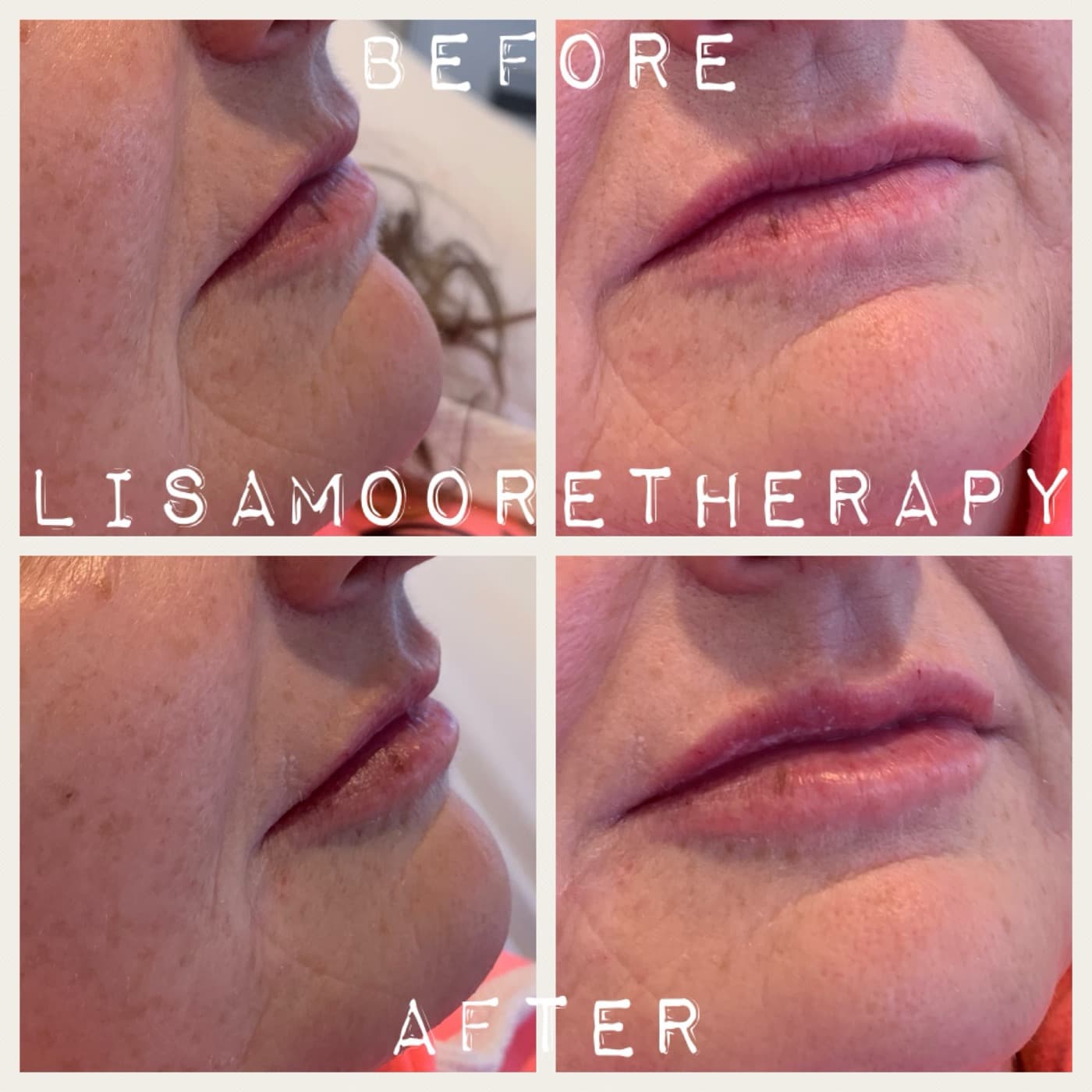 Before and after — Lip enhancement at Lisa Moore Therapy