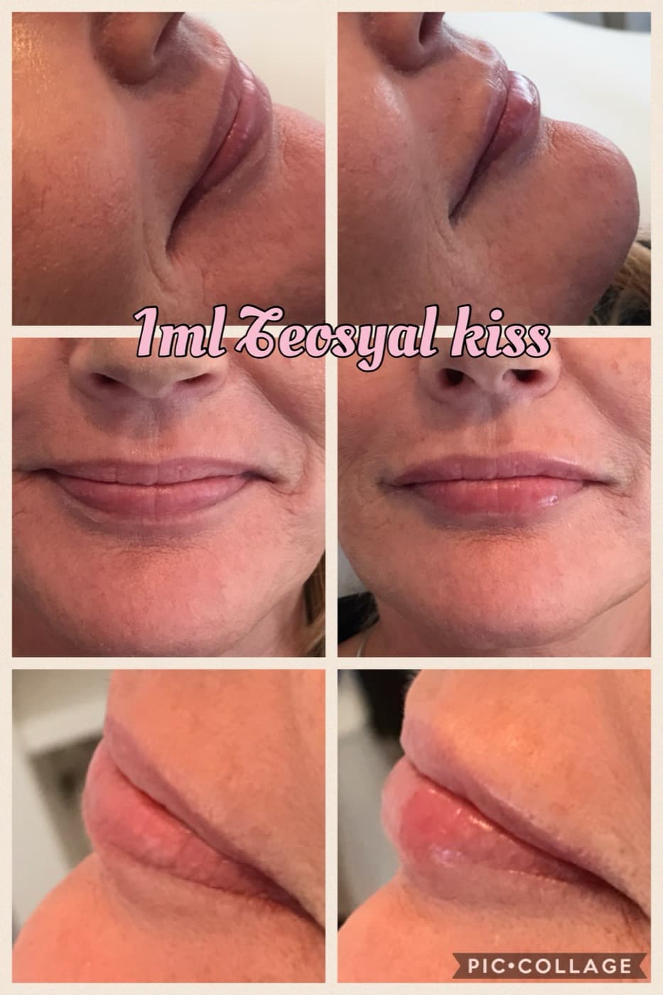 Before and after — Lip enhancement at Lisa Moore Therapy
