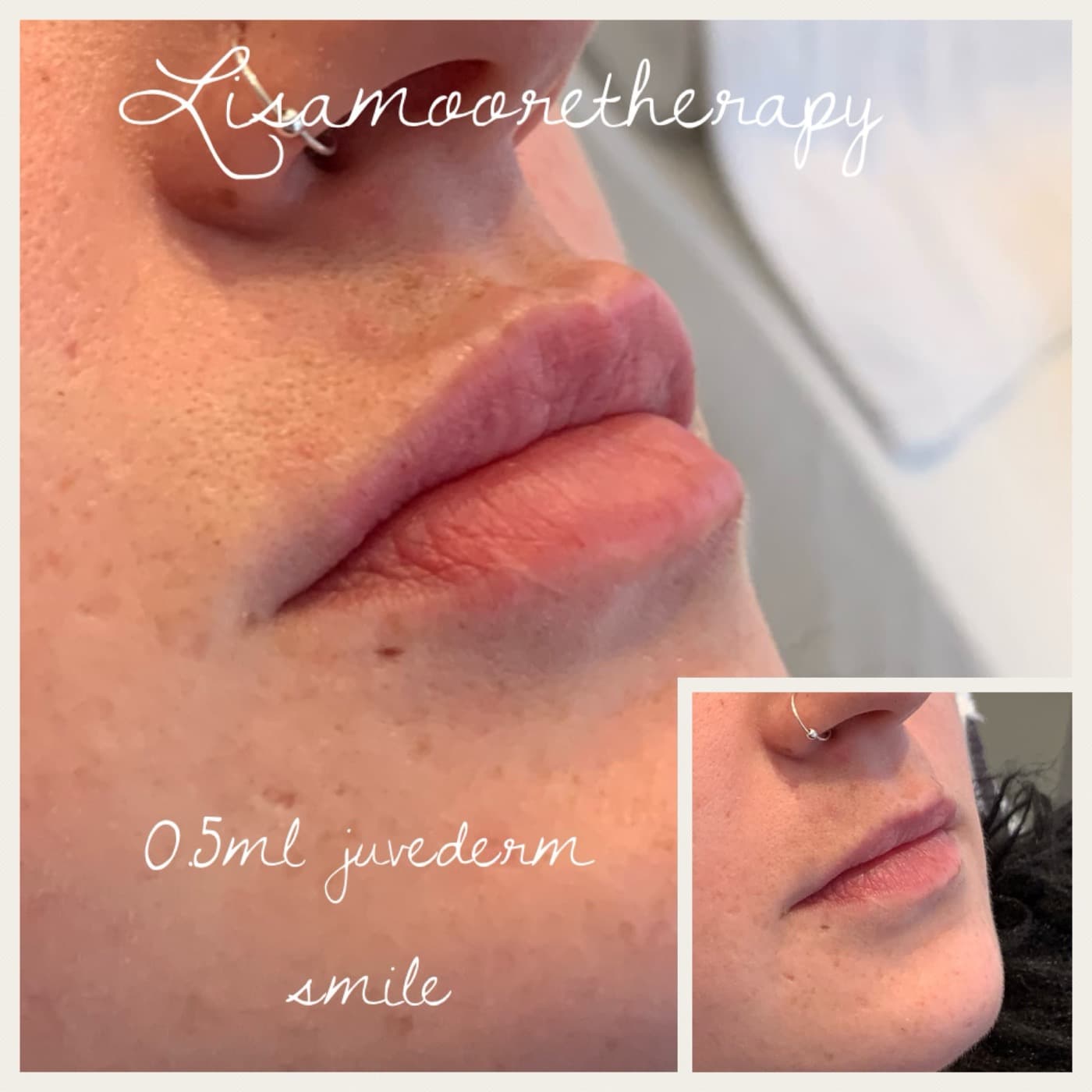 Before and after — Lip enhancement at Lisa Moore Therapy