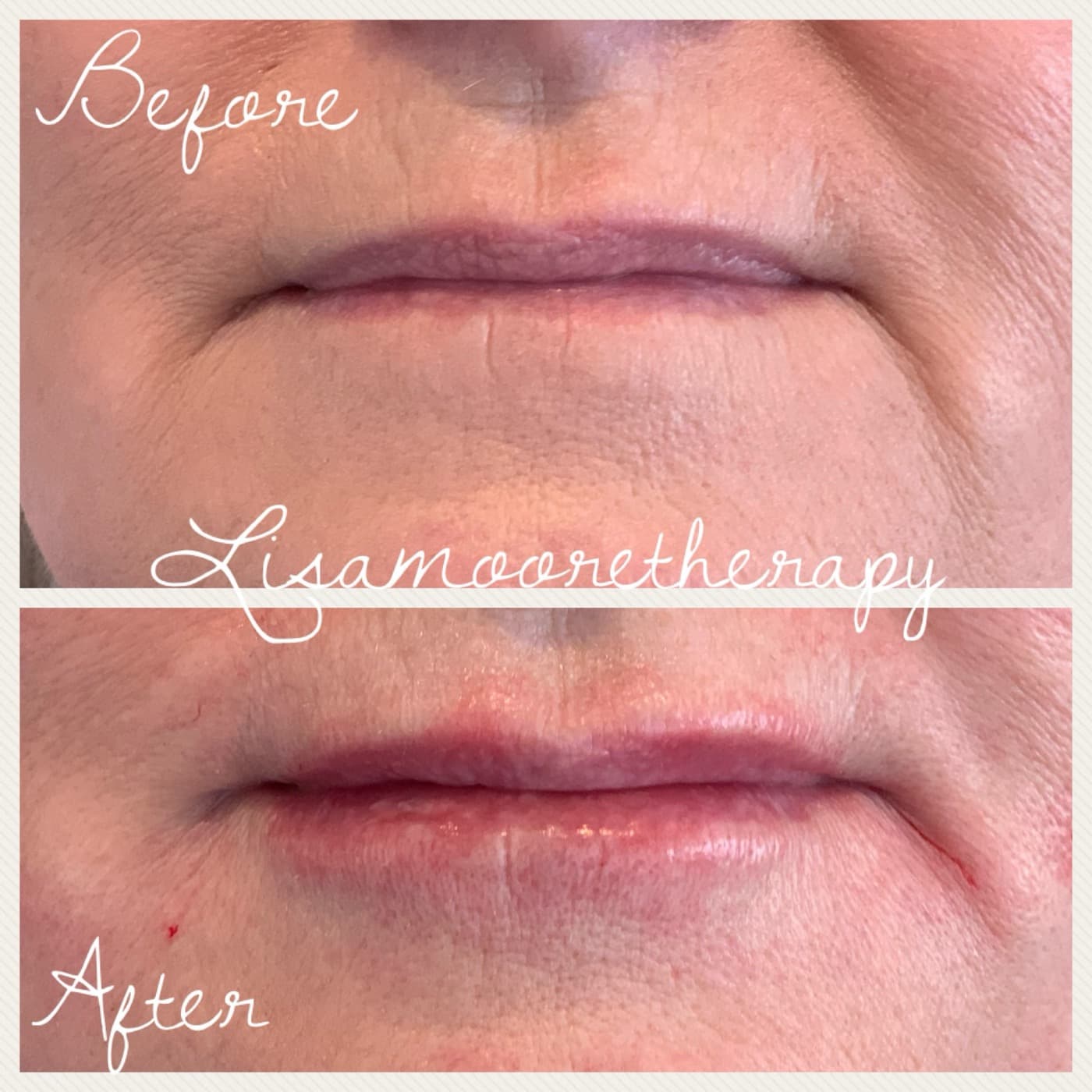 Before and after — Lip enhancement at Lisa Moore Therapy