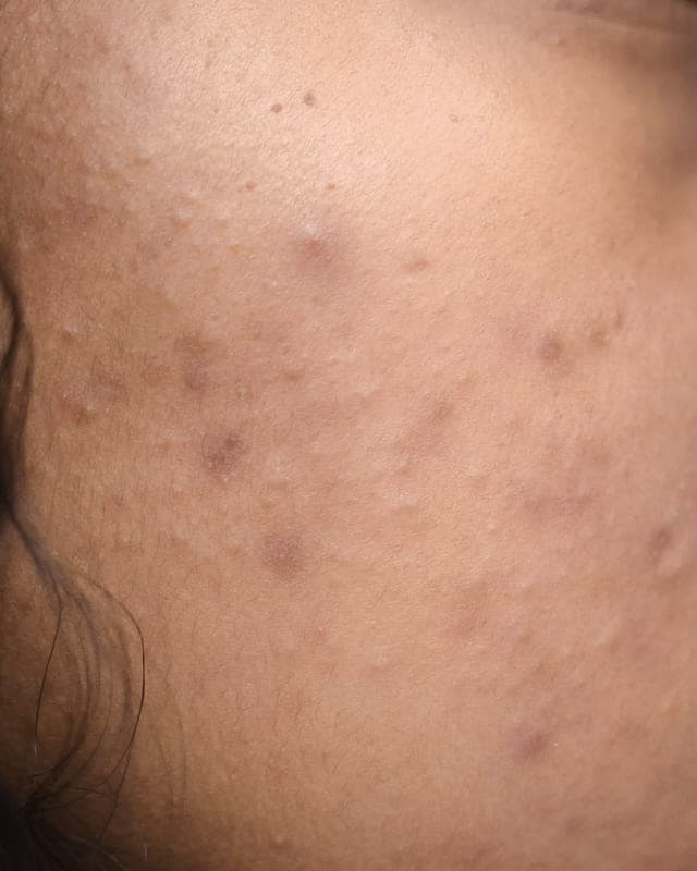 Close-up of a cheek with old acne marks and uneven texture