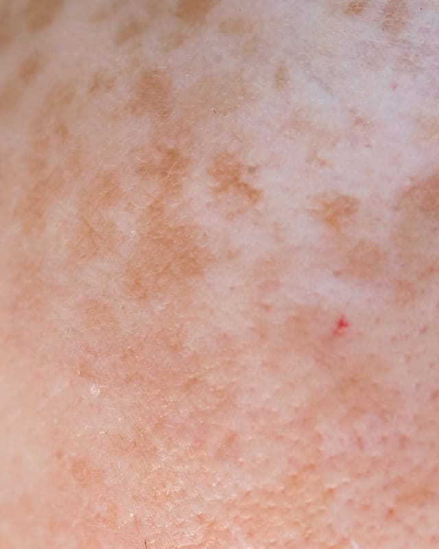 Close-up of skin with uneven patches of pigment